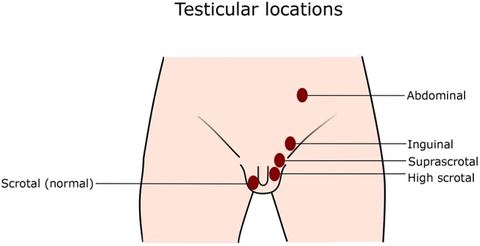 Figure 1: Testicular locations. Normally, both testes locate at the bottom of the scrotum. In cryptorchidism, one or both testes do not stay at the no