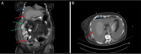 Figure 1: Representative images from CT abdomen/pelvisPertinent findings include: (A) moderate volume of free fluid (red arrows), pneumoperitoneum (bl