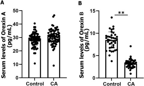FIGURE 1: Serum levels of Orexin A and Orexin B in normal individuals and CA patients. (A) Serum Orexin A levels in normal subjects (29.5 ± 4.21 pg/mL